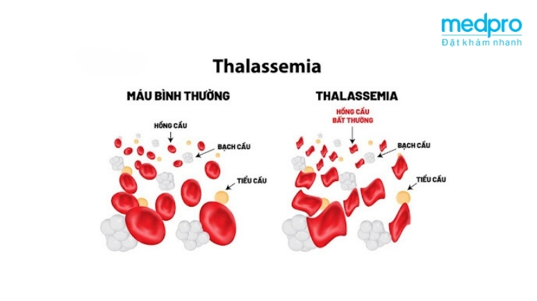 bệnh thalassemia là gì