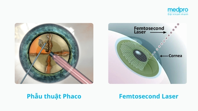 Các phương pháp mổ đục thủy tinh thể