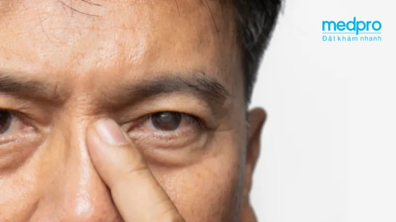 Cườm mắt là gì