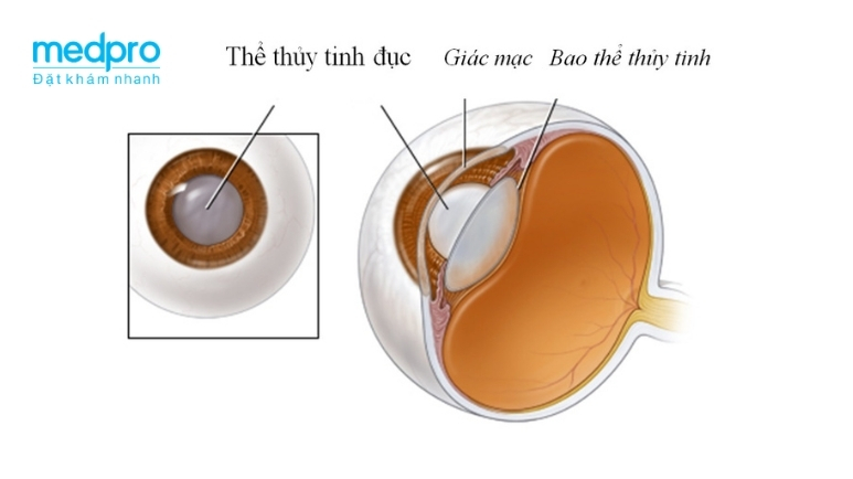 Đục thủy tinh thể có nên mổ không