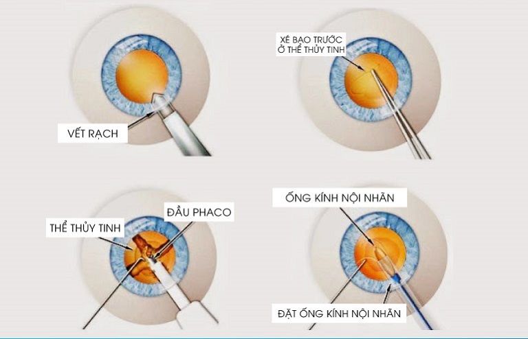 Quy trình phẫu thuật Phaco