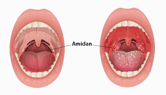 Viêm Amidan